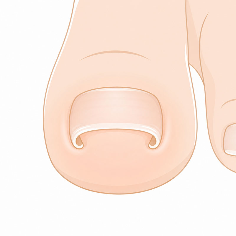 巻き爪のイメージ